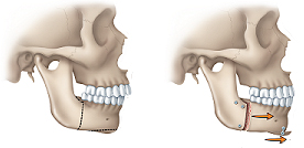 Pittsburgh Corrective jaw Surgery